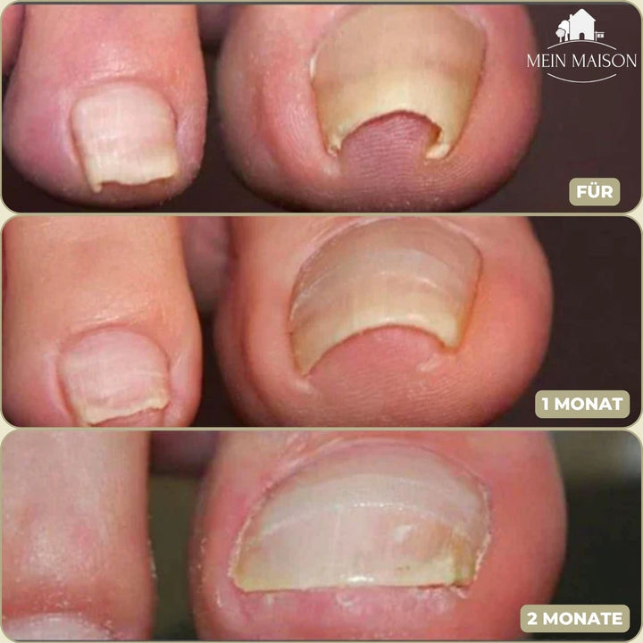 Carvallo | FixaNail - Omedelbar Nagelreparation
