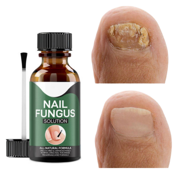 Avancerat svampdödande nagelserum – Snabb lindring av tånagel- och fingernagelinfektioner
