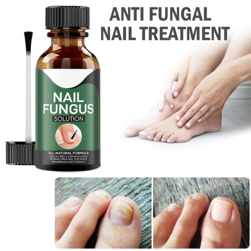 Avancerat svampdödande nagelserum – Snabb lindring av tånagel- och fingernagelinfektioner